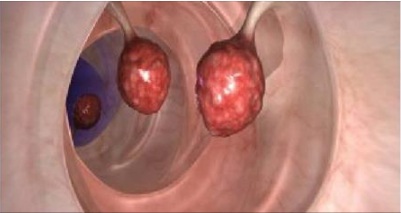 Les médecins sont en état de choc: cette huile peut tuer jusqu’à 93% de cellules tumorales du cancer du côlon en 2 jours seulement!