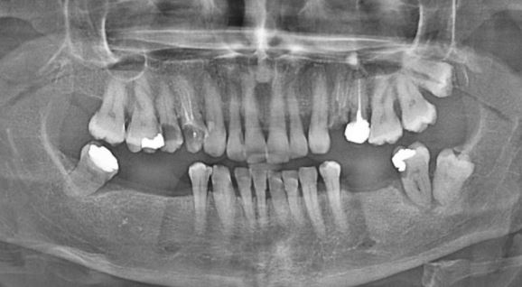 Dites adieu aux implants dentaires : un dentiste fait pousser de nouvelles dents en seulement 9 semaines