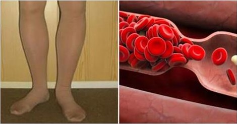 Votre corps vous avertit quand un caillot de sang se forme : 8 signes que vous ne devriez pas négliger