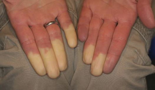 Qu’est-ce que la maladie et le syndrome de Raynaud qui se manifestent au froid ?