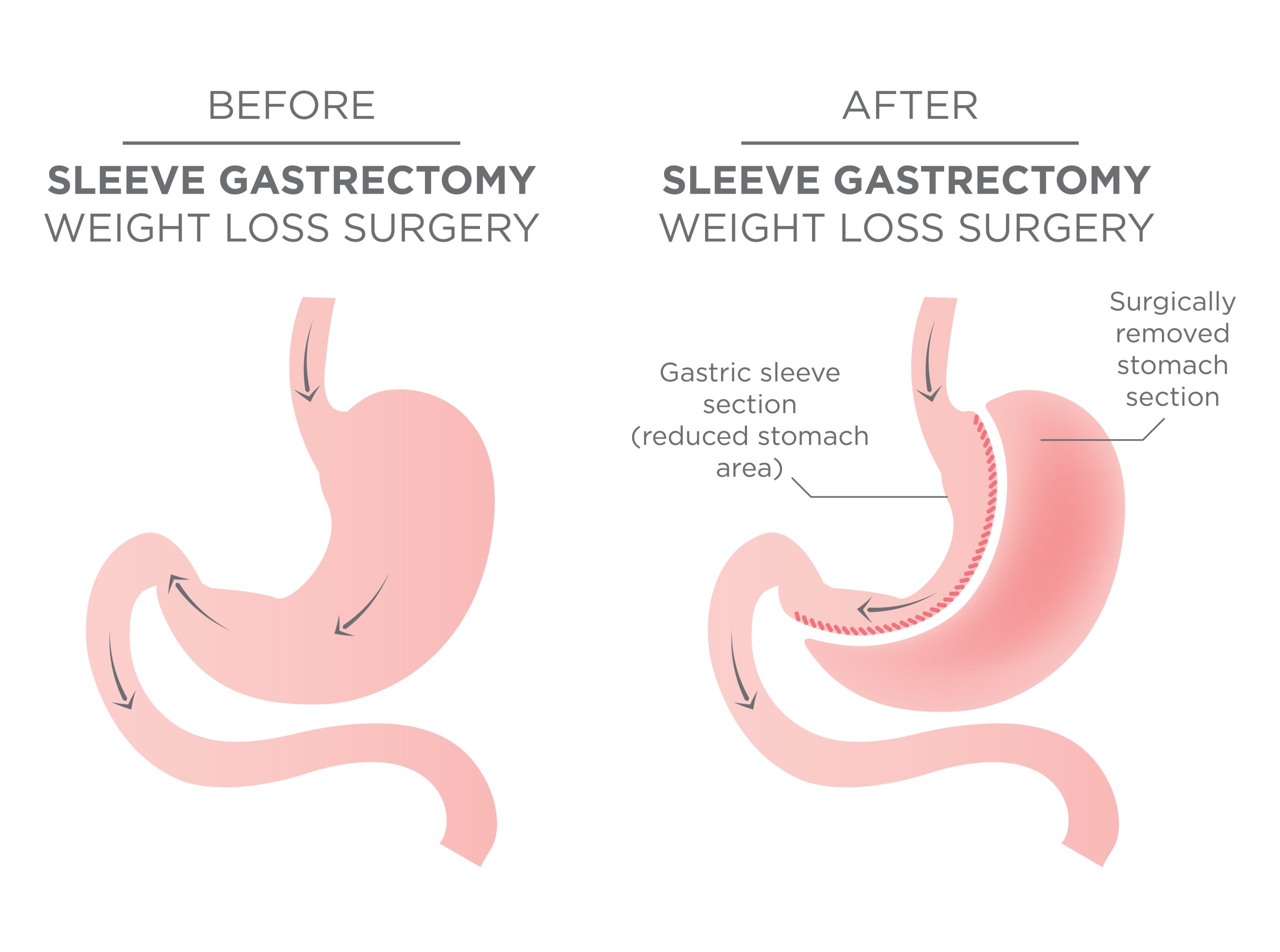 gastric_sleeve_anatomi