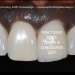 Direct een vaste tand – Edith Groenendijk Implantologie Den Haag