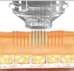 EPN Microneedling and Electroporation Mode Laser Skin Clinic