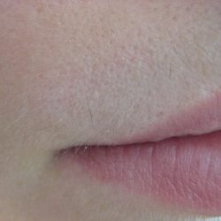 LIP after 7 treatments MG_1474