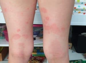 childhood eczema