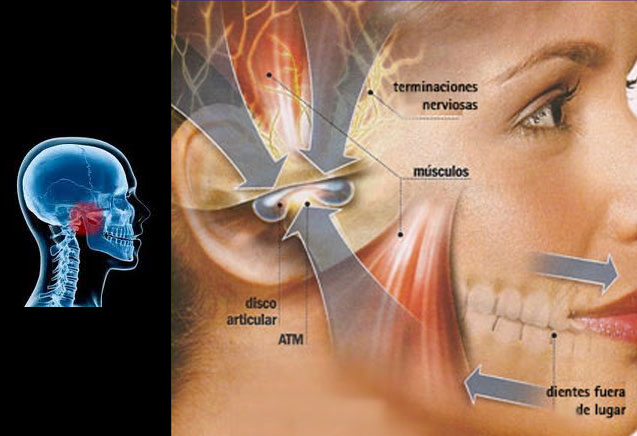 Disfunciones en la ATM (articulación temporomandibular)