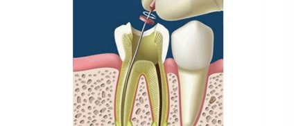 Endodoncia