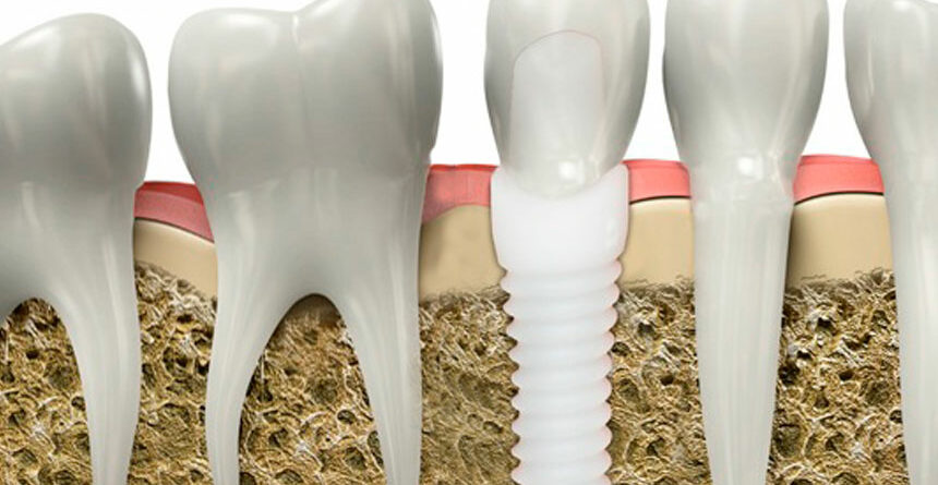 IMPLANTES CERÁMICOS