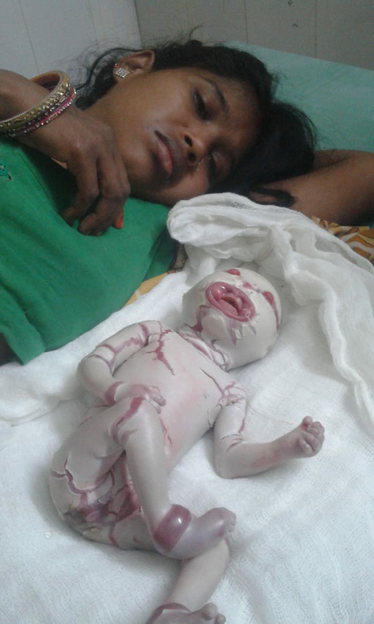 बहराइच जिले की एक महिला ने जन्म दिया कोलोडियन बच्चा, स्वास्थ्य कर्मियों के उड़े होश | New India Times