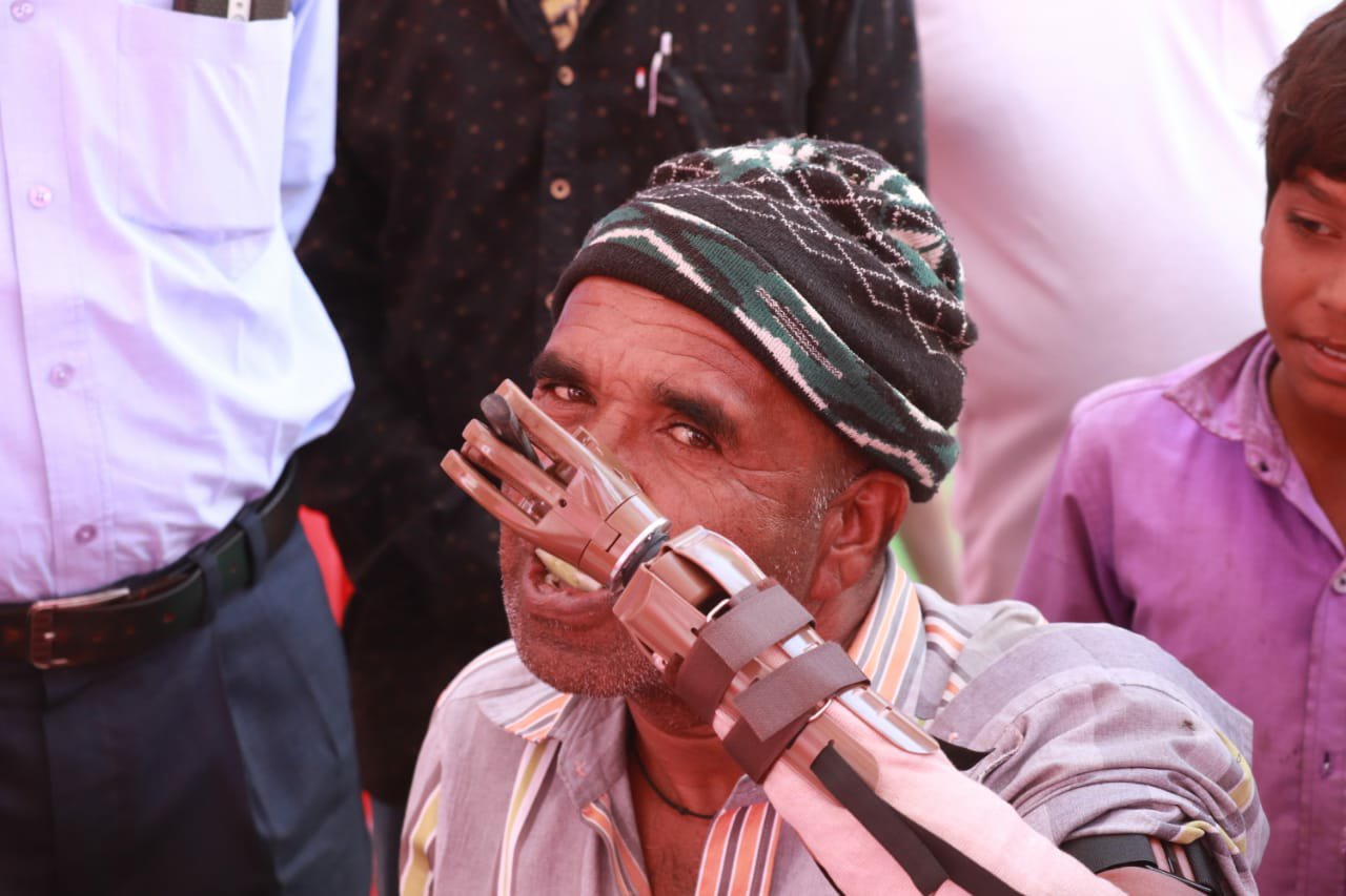 प्लास्टिक सर्जरी शिविर के 7 वें दिन हुए 63 सफल ऑपरेशन, कृत्रिम हाथ लगाते ही पहले उस हाथ से अपना नाम लिखा | New India Times