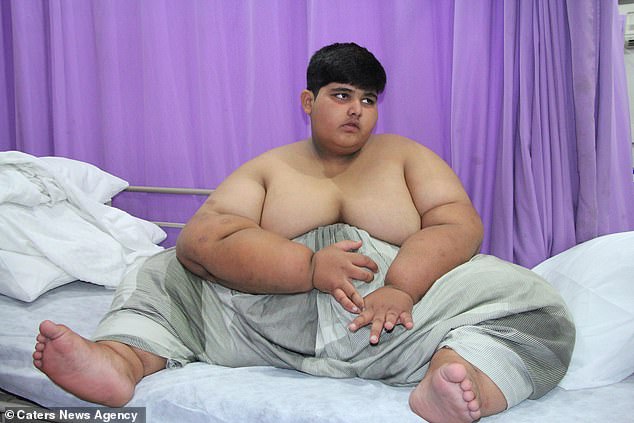 Mohammed Arbrar, from Pakistan, is the world's fattest child weighing a whopping 31 stone at just 10 years old