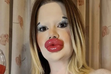 I have the ‘world’s biggest lips’ - but now I’m going to set a NEW world record