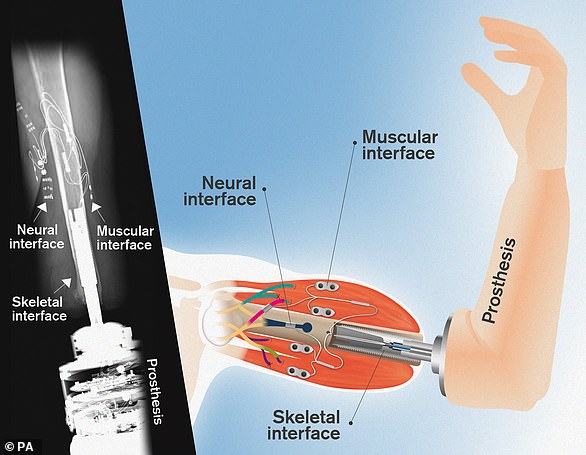 Three people in Sweden use an implant system that allows amputees to use a bionic arm with just their thoughts. Dr Max Ortiz Cataln at Chalmers University of Technology hopes the technology can be expanded to Europe. The implant system anchors the prosthesis to the skeleton in the stump of the amputated limb