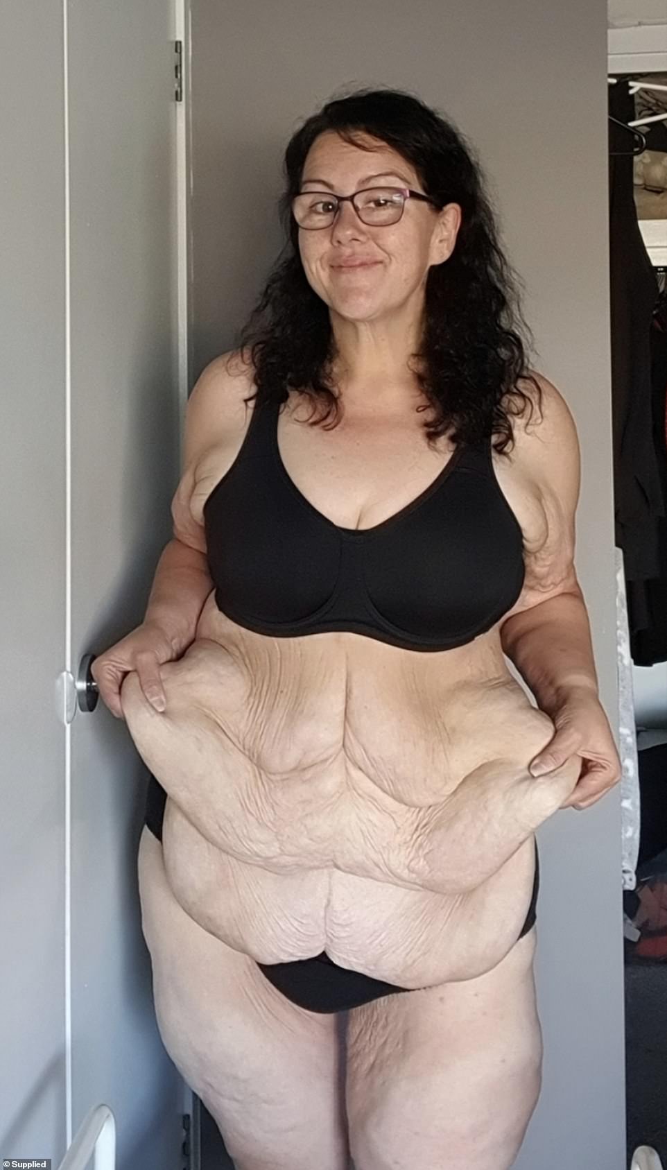 After her gastric sleeve surgery, Brenda needed to have her excess skin removed