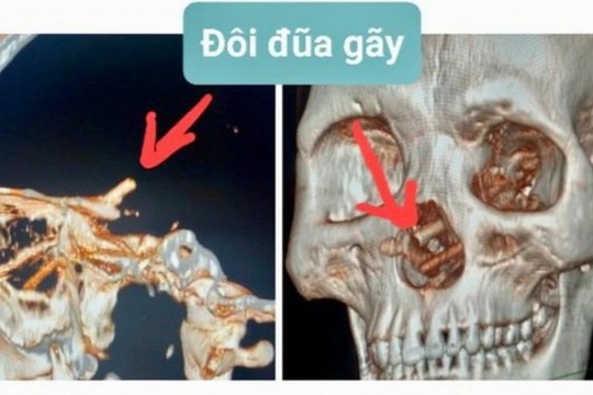 The broken chopsticks can be seen in the 3D rendered CT scan and they had been lodged in his brain from his nose (Picture: Vietnam Cuba Hospital) 