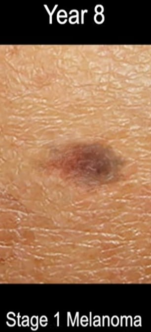 The above shows stage 1 melanoma