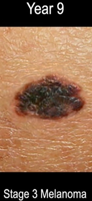This shows stage three melanoma