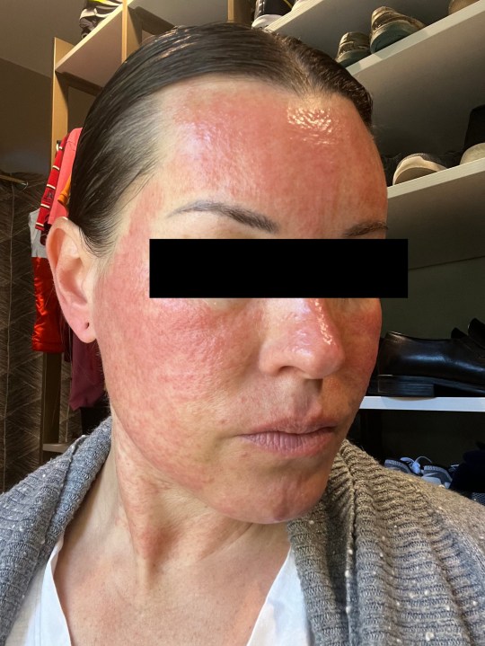 Morpheus8 ruined our skin: Jessica's skin afterwards