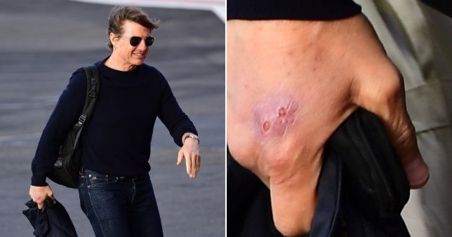 Tom Cruise injured hand in London