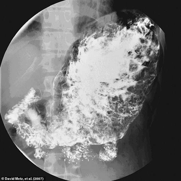 This x-ray shows a competitive eater's stomach after consuming 36 hotdogs and buns. The study found that the stomach had become a 'dilated, flaccid sac' after years of training