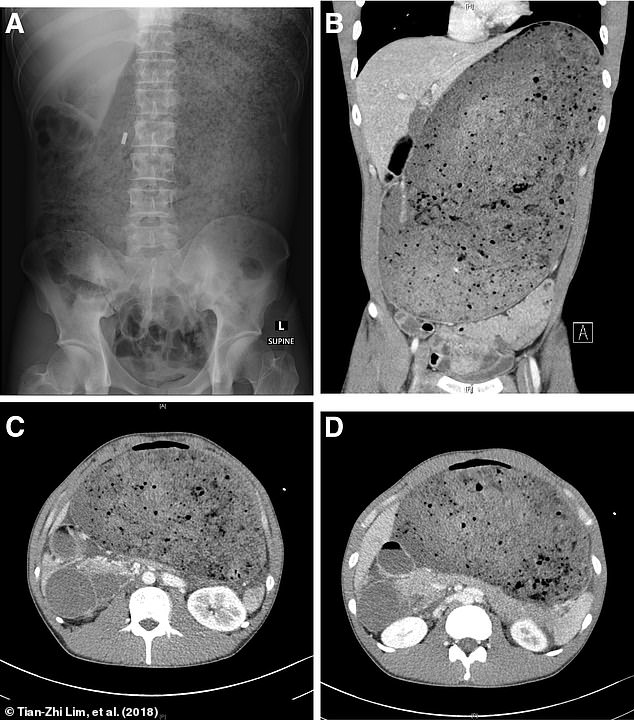 These X-rays show the stomach of a patient who was hospitalised for five days after eating a 3.2 kg burger in 30 minutes