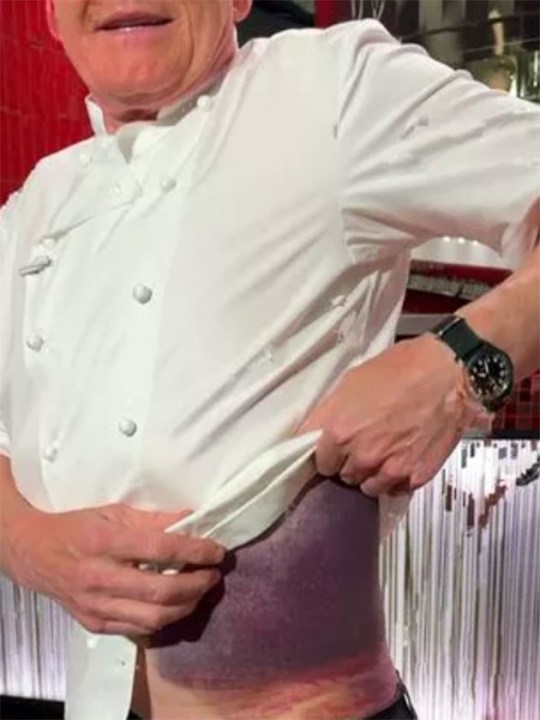 Gordon Ramsay reveals huge bruise after horror bike accident