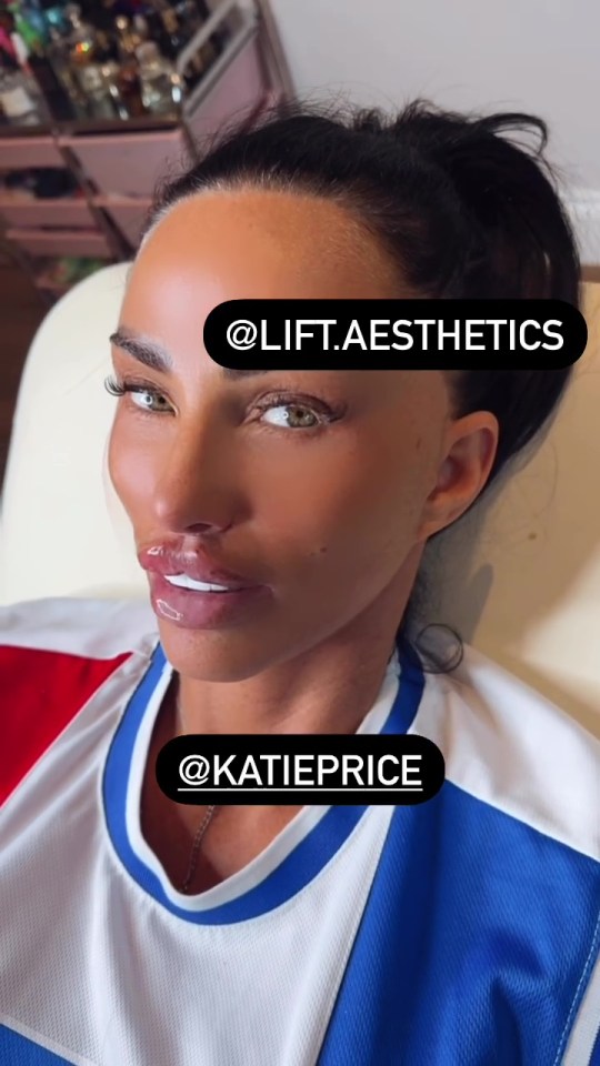 She has had her pout injected with more filler