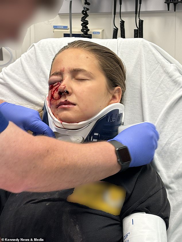 Kylie Dean was taken to the hospital following her crash, which 'shattered' her right eye socket