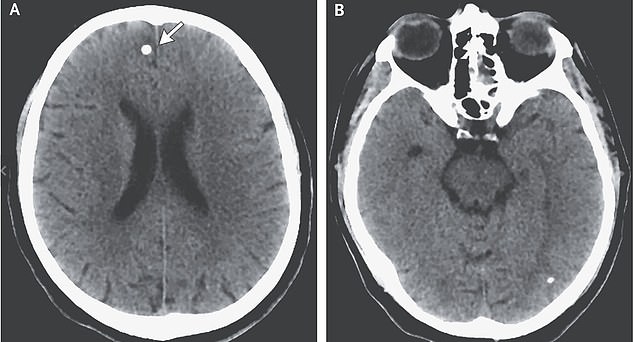 Cysticercosis can also affect the brain as was the case for TE, these brains cans show one patient, a 38-year-old man from the US, who developed similar problems as TE due to eggs adversely affecting the sensitive organ