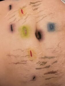 Barriga con estrías y cicatrices pintadas con diferentes colores