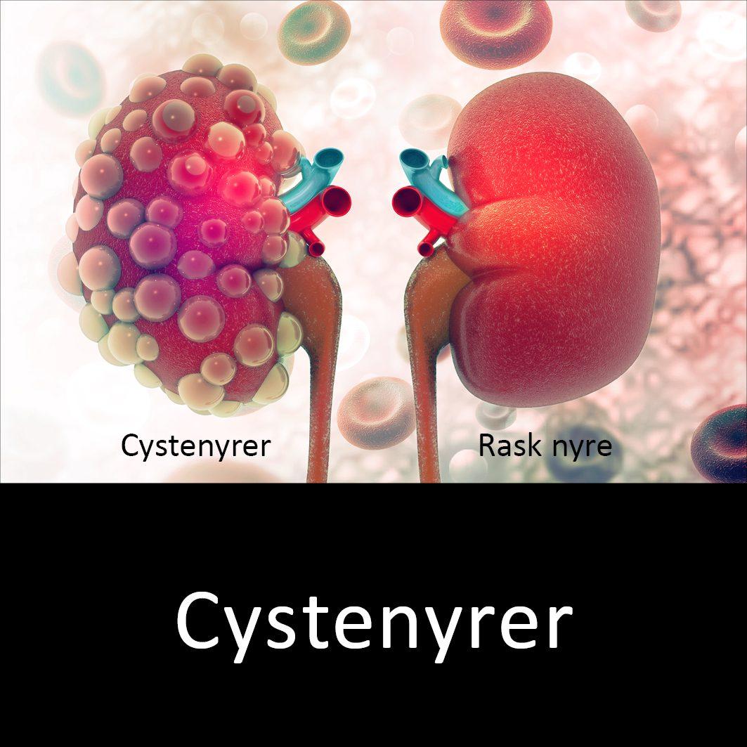 Diabetisk nyresygdom