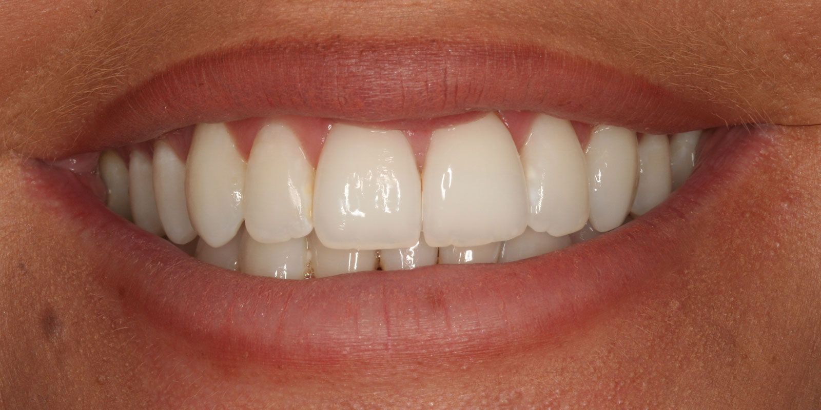 http://Invisalign%20After
