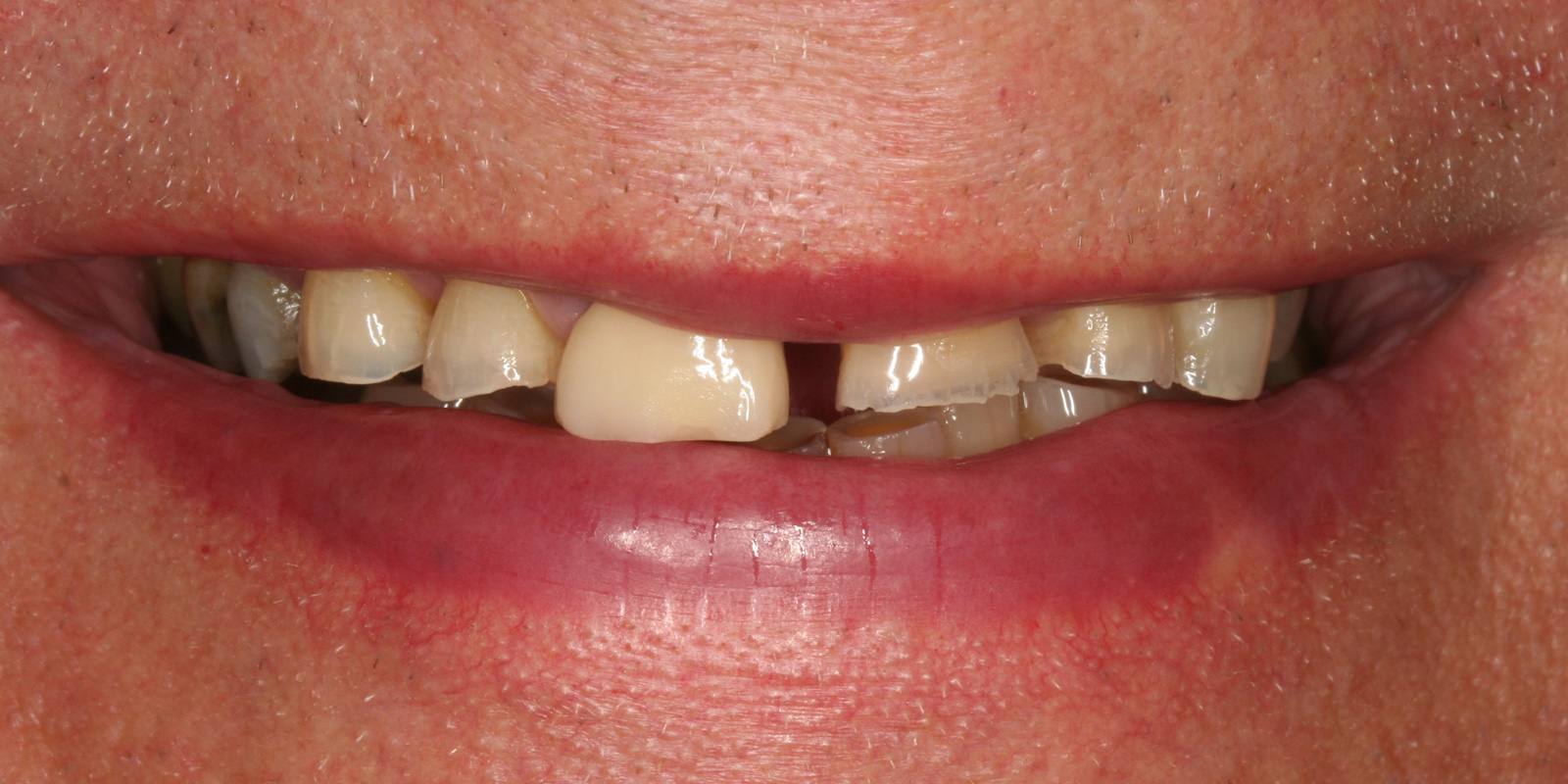 http://Toothwear%20Before