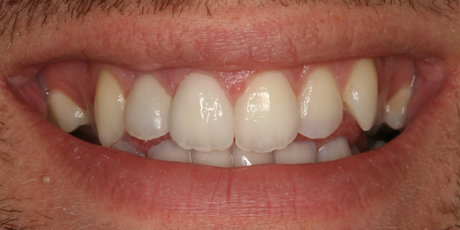 http://Veneers%20after