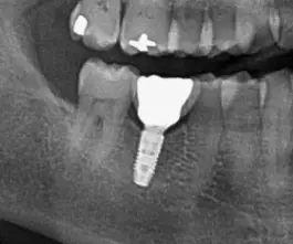 Røntgenbillede viser tandimplantat fastgjort i underkæben