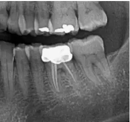 Røntgenbillede af tand med rodbehandling hos Tandlægerne Ølandshus