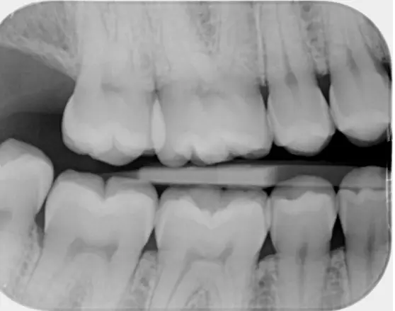 Bitewing-røntgenbillede optaget hos tandlægerne Ølandshus på Amager.