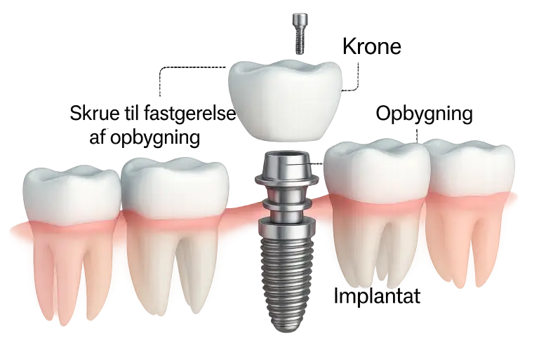 Illustration af tandimplantat med krone, opbygning og skrue til fastgørelse