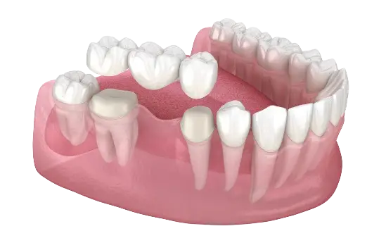 3D-illustration af tandbro til erstatning af manglende tænder i underkæben
