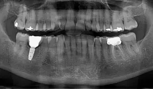 Panoramarøntgen (OPG) fra tandlægerne Ølandshus på Amager med synlige fyldninger og implantat.