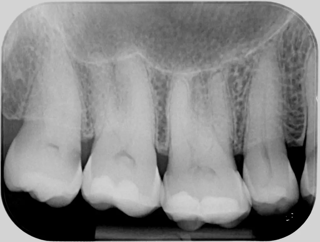 Periapikalt røntgenbillede hos tandlægerne Ølandshus på Amager med fokus på kindtænder.