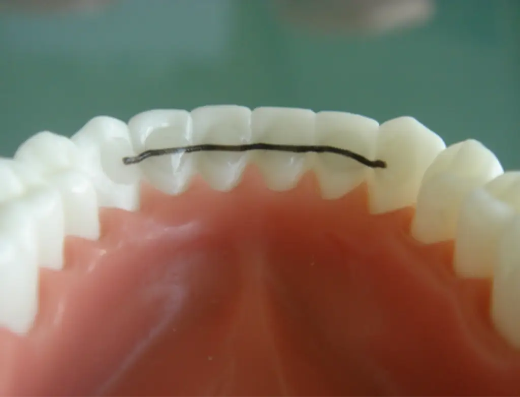 Fast retainer på tandmodel anvendt efter tandretning