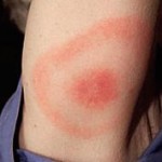 Erythema Migrans, de rode vlek met rode kring rondom. Besmetting is zeker.