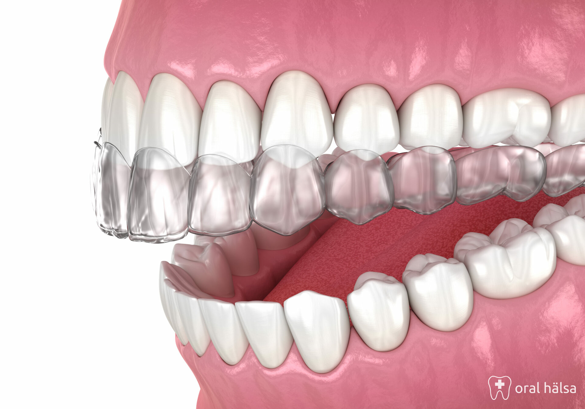 Invisalign