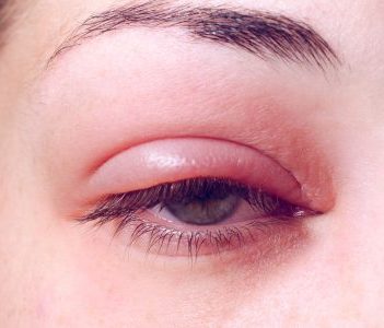 ögonlocksinflammation