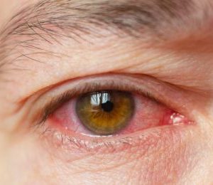 ögoninflammation