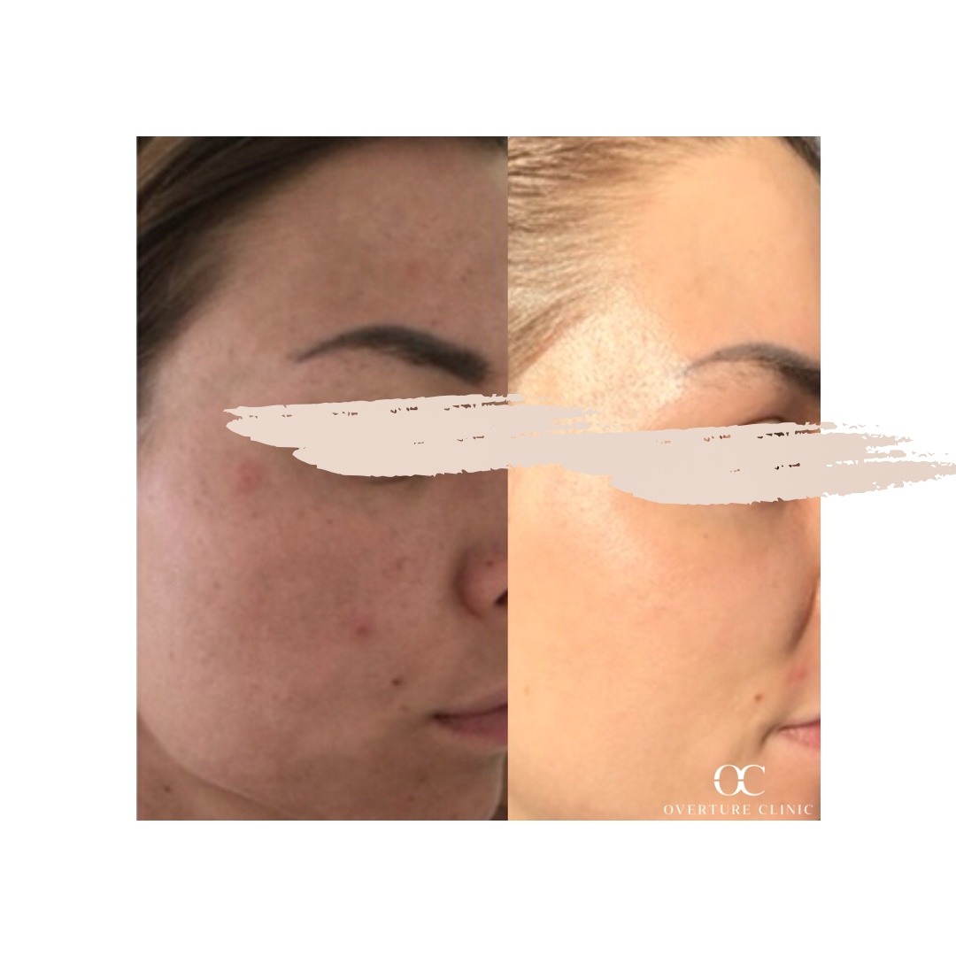 Zein Obagi Peeling - Overture Clinic