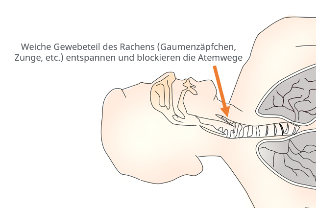 Grafik Schlafapnoe