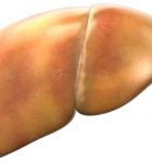 Image of a fatty liver - Stage 1-2 of fatty Liver