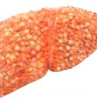 Liver cirrhosis - Stage 4